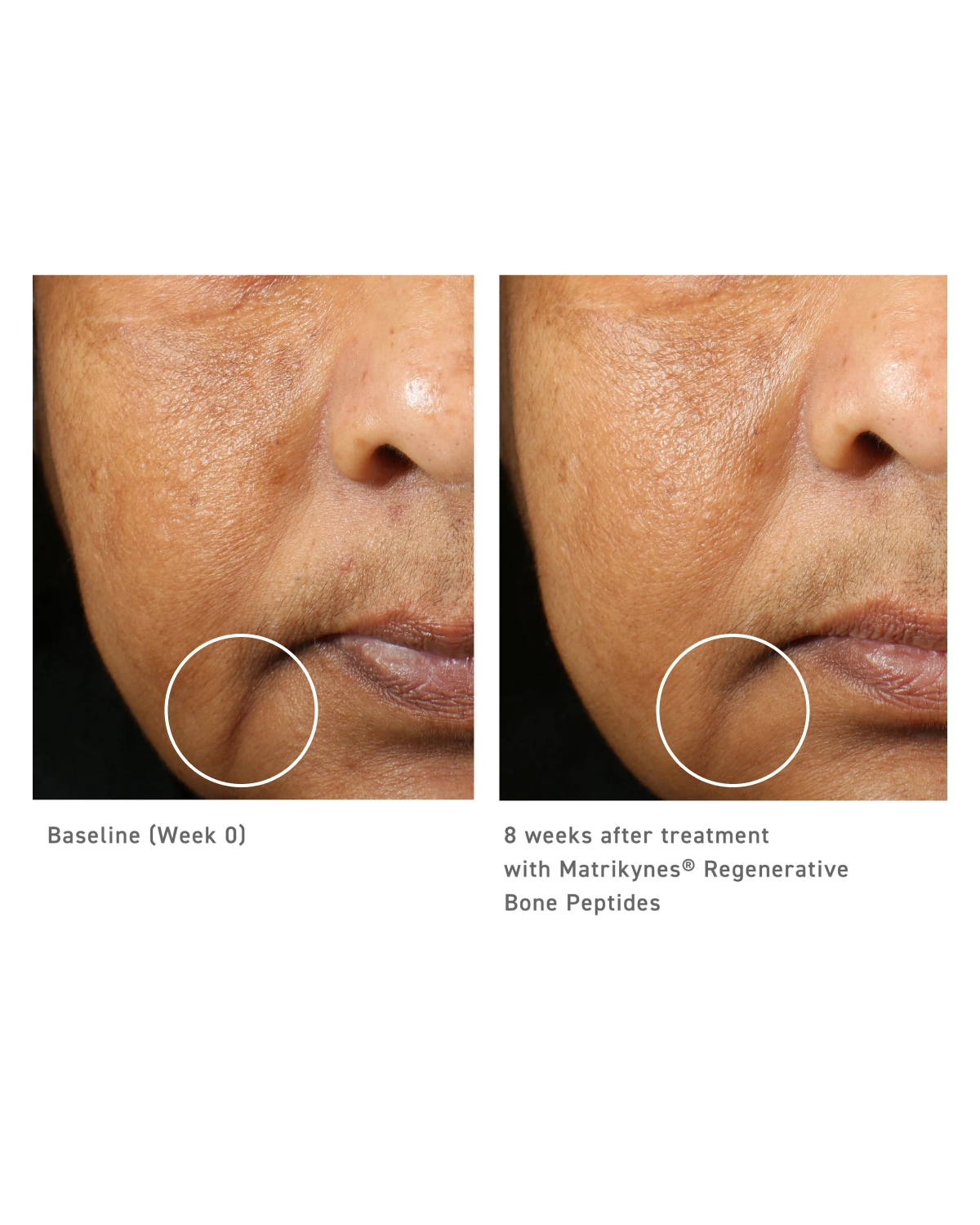 Baseline (Week 0) and 8 weeks after treatment with Matrikynes® Regenerative Bone Peptides, lines beside the mouth