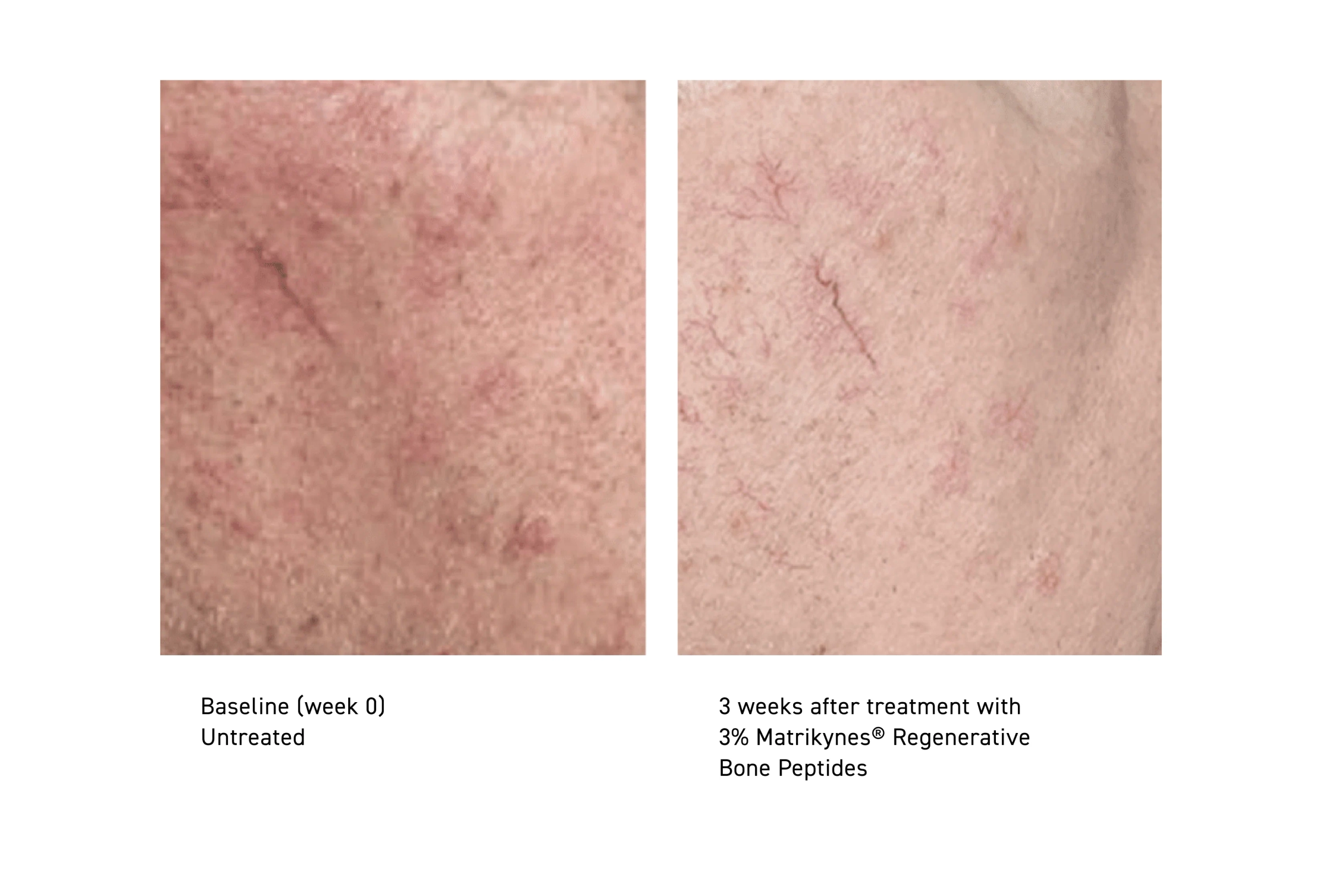 Baseline (week 0), untreated, and 3 weeks after treatment with 3% Matrikynes® Regenerative Bone Peptides, cheek skin tone