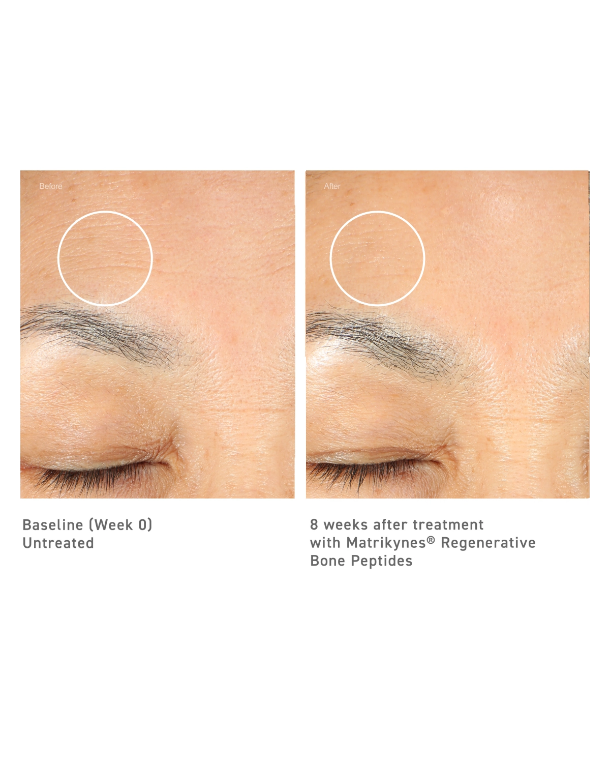 Baseline (Week 0) and after treatment with Matrikynes® Regenerative Bone Peptides, skin around the eye