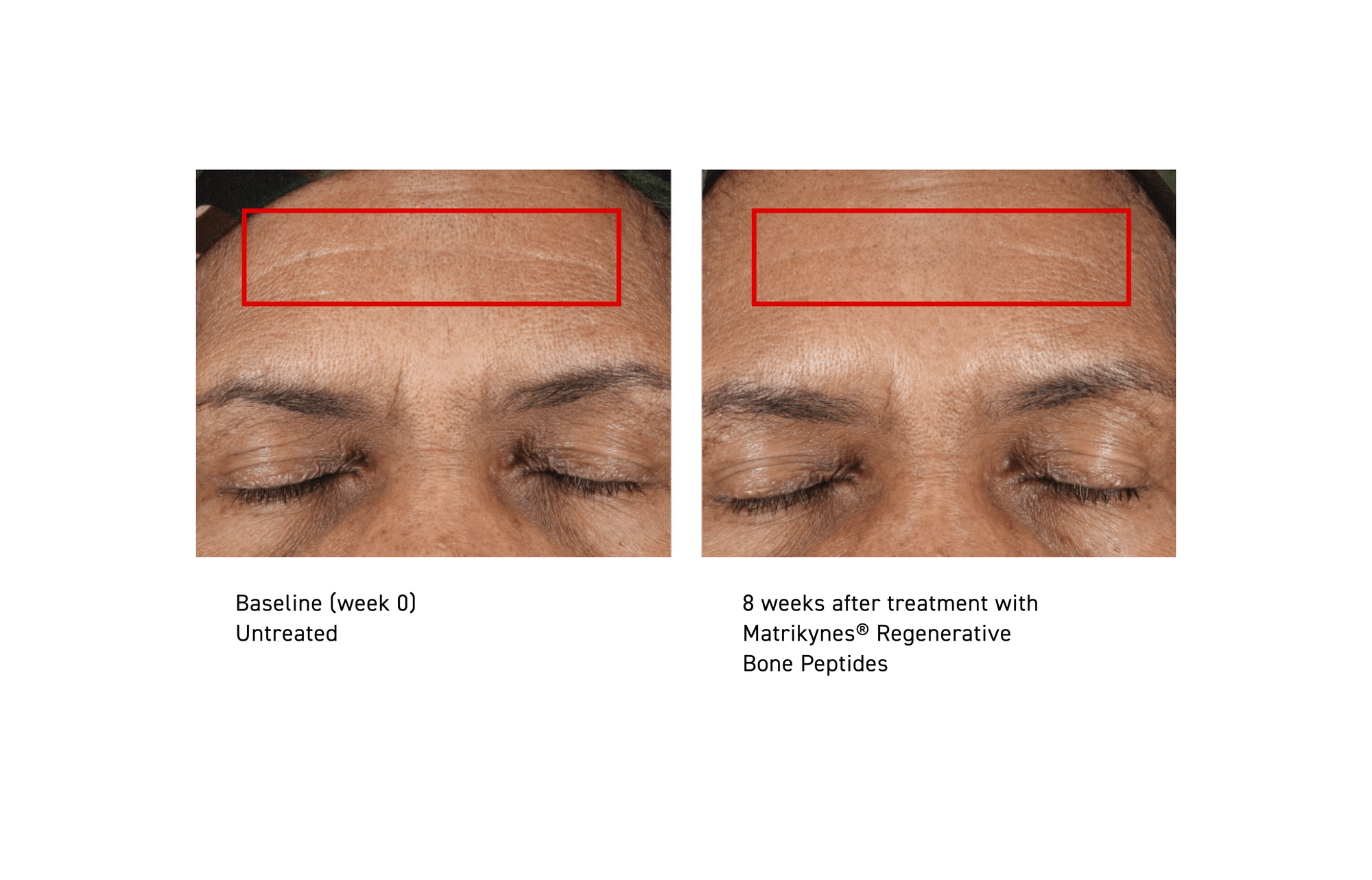 Baseline (Week 0), untreated, and after treatment with Matrikynes® Regenerative Bone Peptides, forehead lines